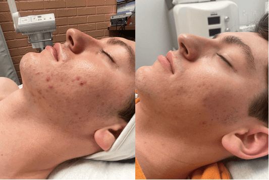 7 tips to reduce acne effectively - Espace Skins Montreal