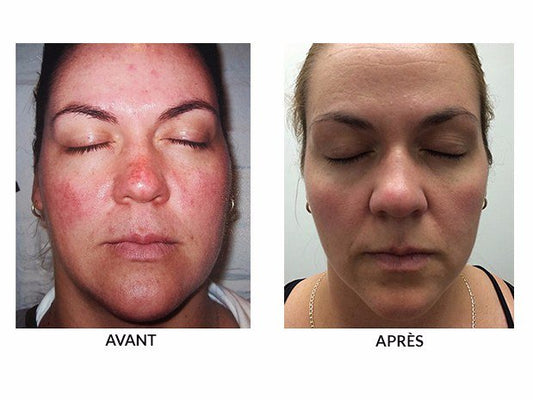 HOW TO TREAT ROSACEA : SKINS CASE STUDY - Espace Skins Montreal