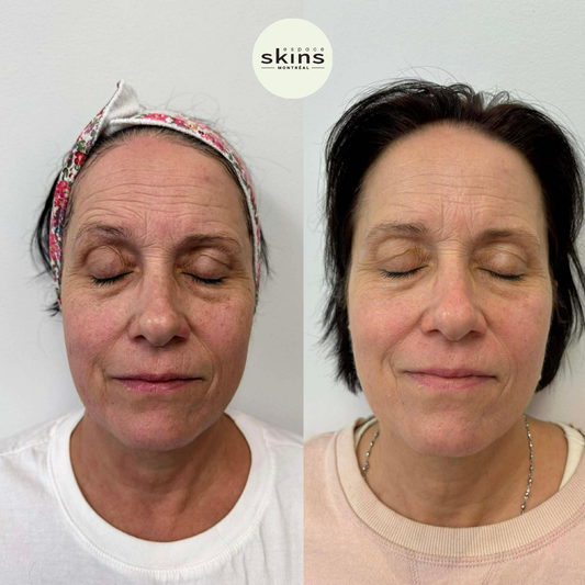 Laser Chrome - 3 protocoles distincts