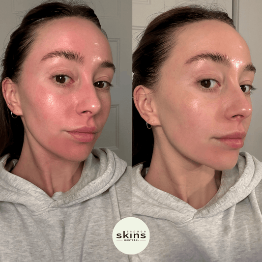 CO2 Treatment - Espace Skins Montreal