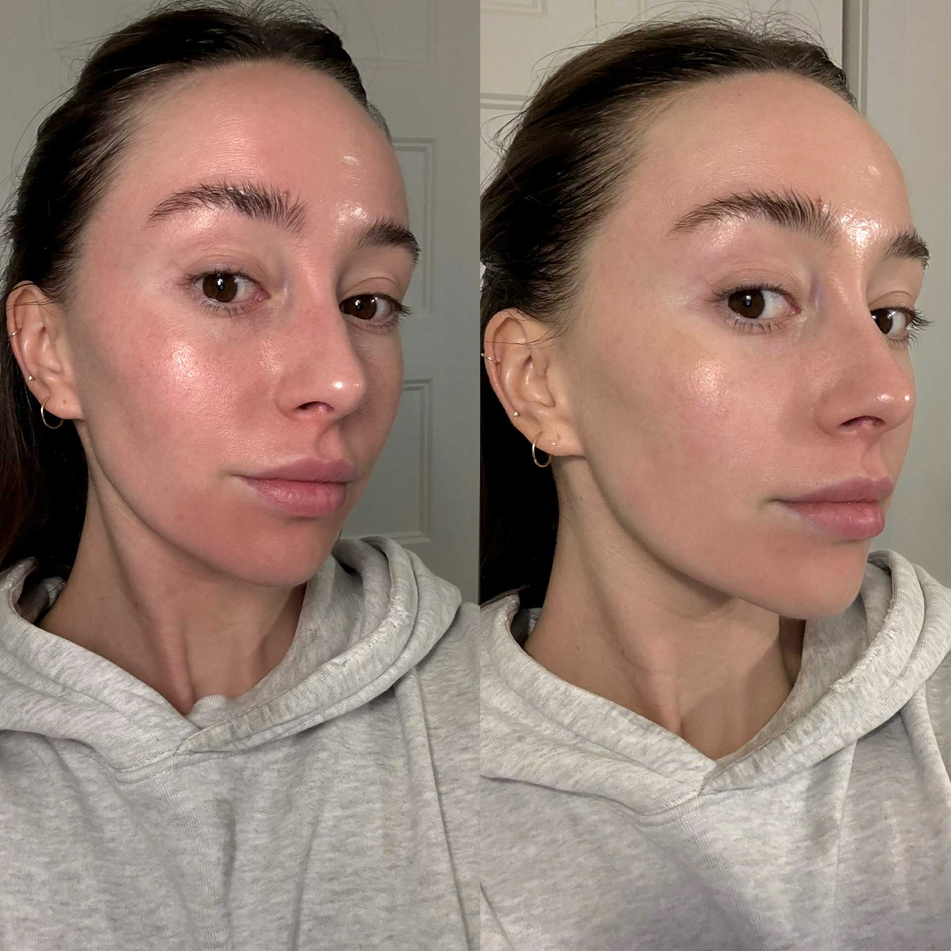 CO2Lift® Carboxy Gel Treatment(s) - Espace Skins Montreal