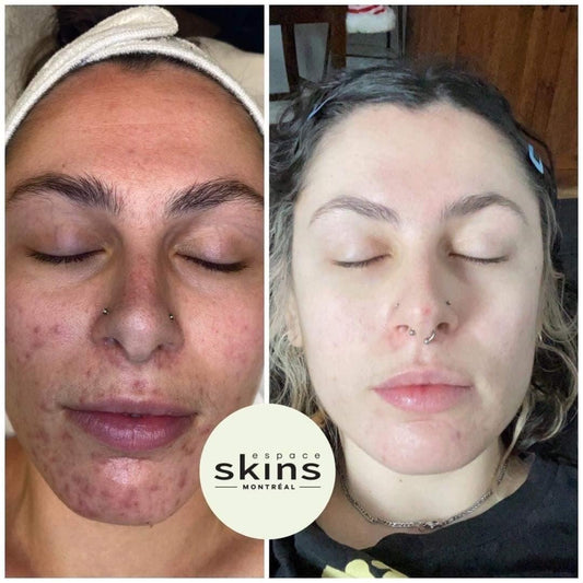 IPL Acne Treatment (Pulsed Light) - Espace Skins Montreal