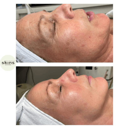 Me Line Peeling (+3 products) - Espace Skins Montreal