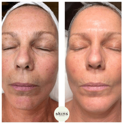 Me Line Peeling (+3 products) - Espace Skins Montreal