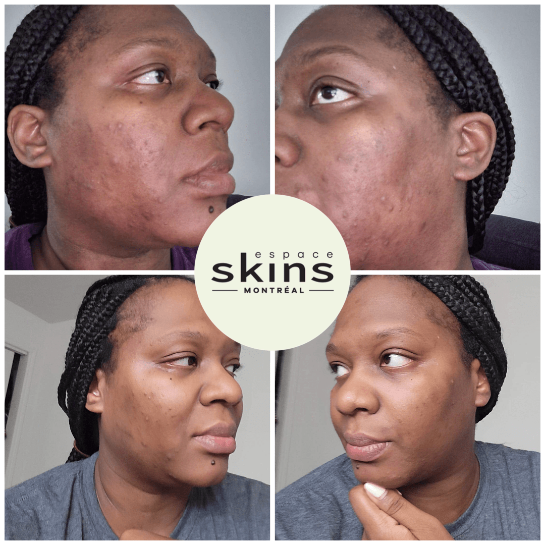 Me Line Peeling (+3 products) - Espace Skins Montreal