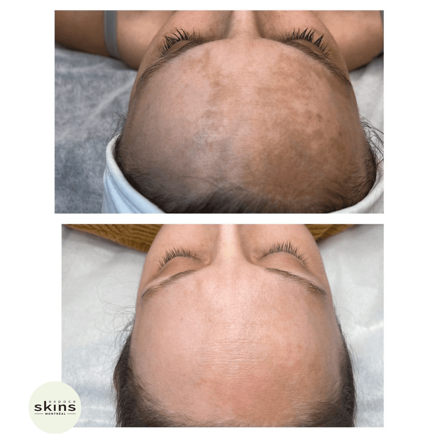 Me Line Peeling (+3 products) - Espace Skins Montreal