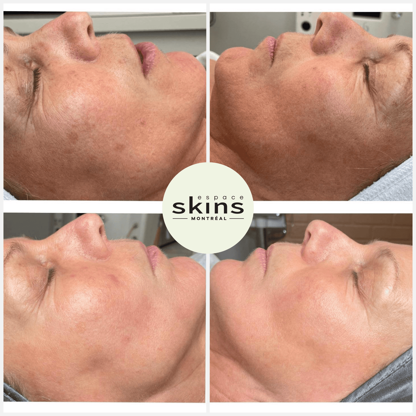 Me Line Peeling (+3 products) - Espace Skins Montreal
