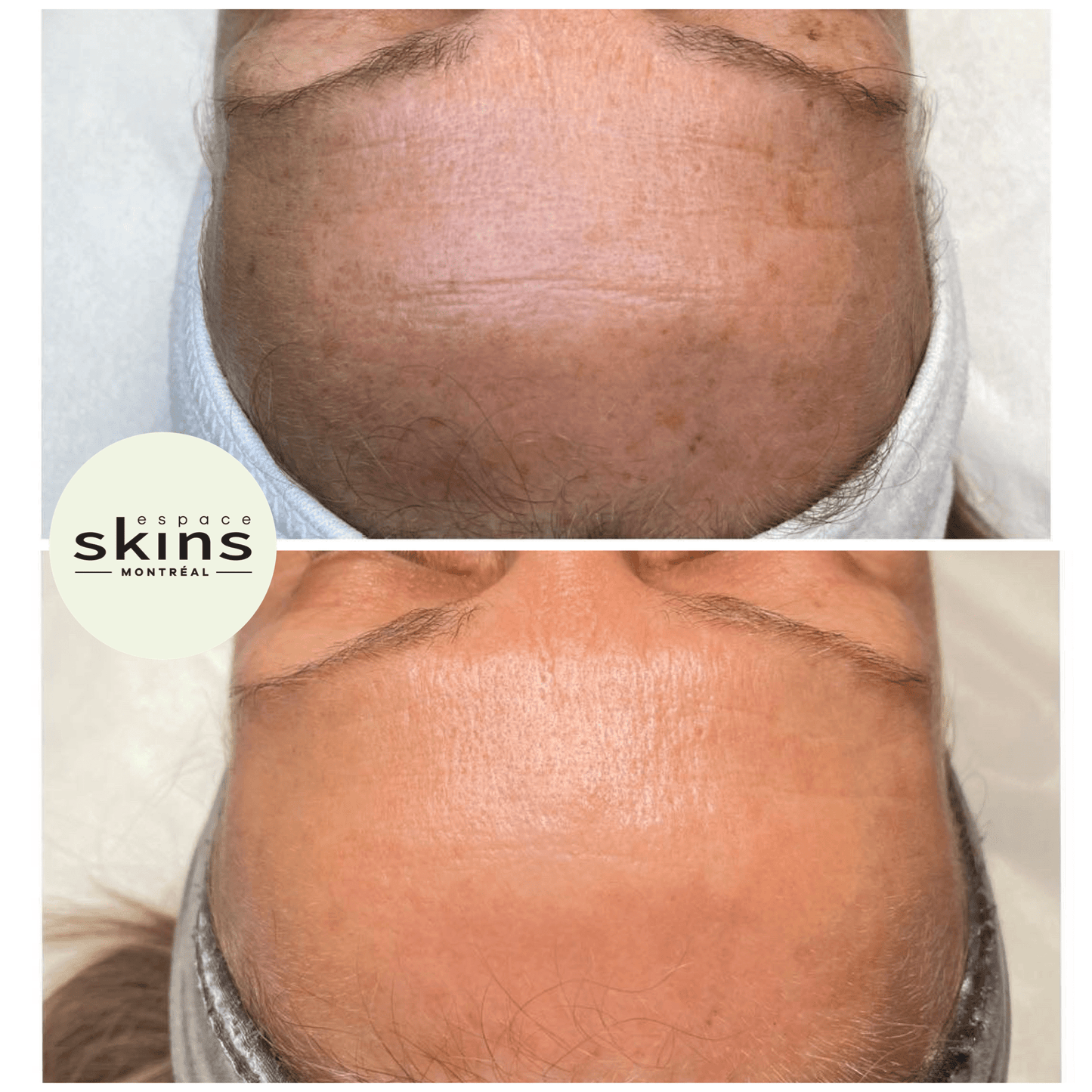 Me Line Peeling (+3 products) - Espace Skins Montreal