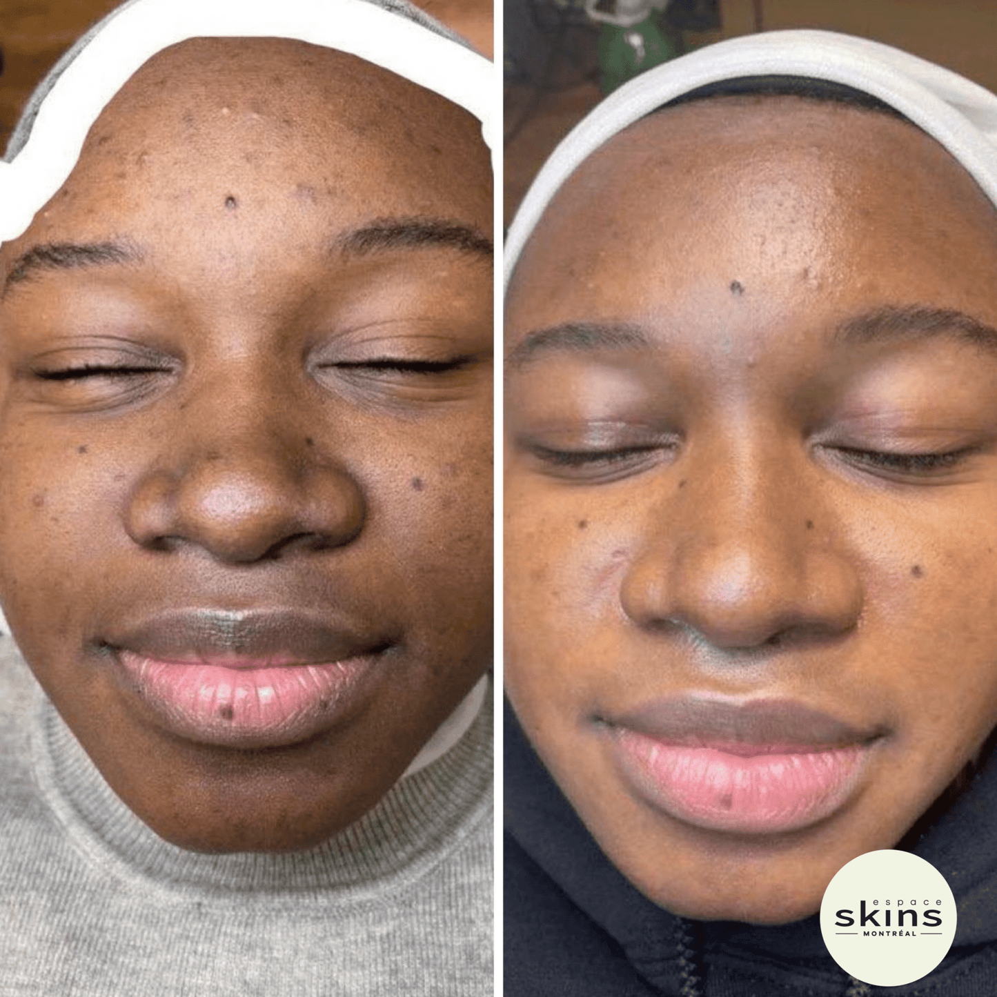 Me Line Peeling (+3 products) - Espace Skins Montreal