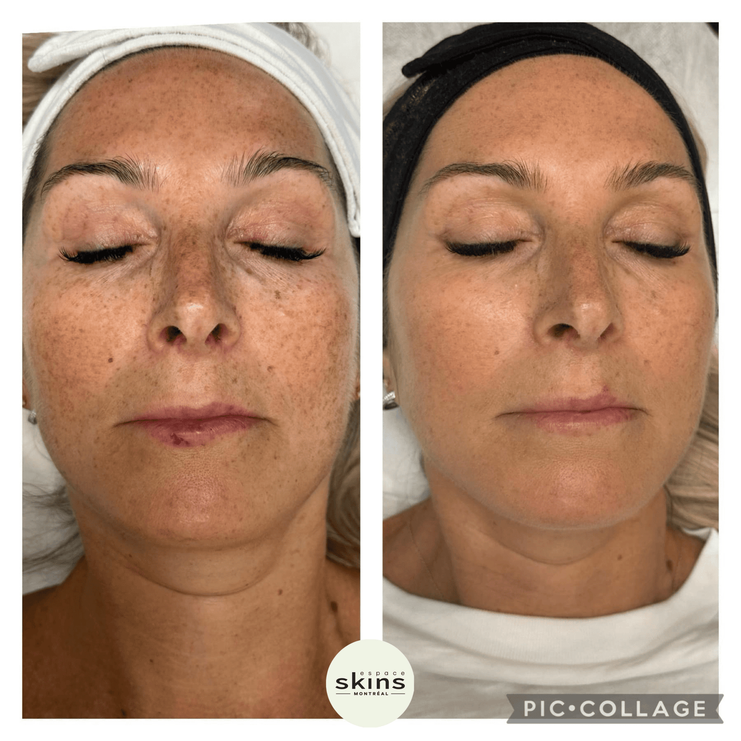 Me Line Peeling - Espace Skins Montreal