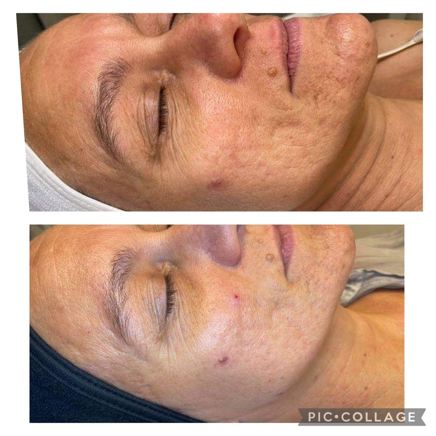 Microneedling