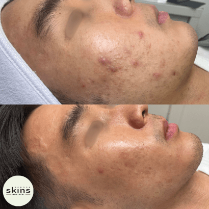 Peeling - Espace Skins Montreal