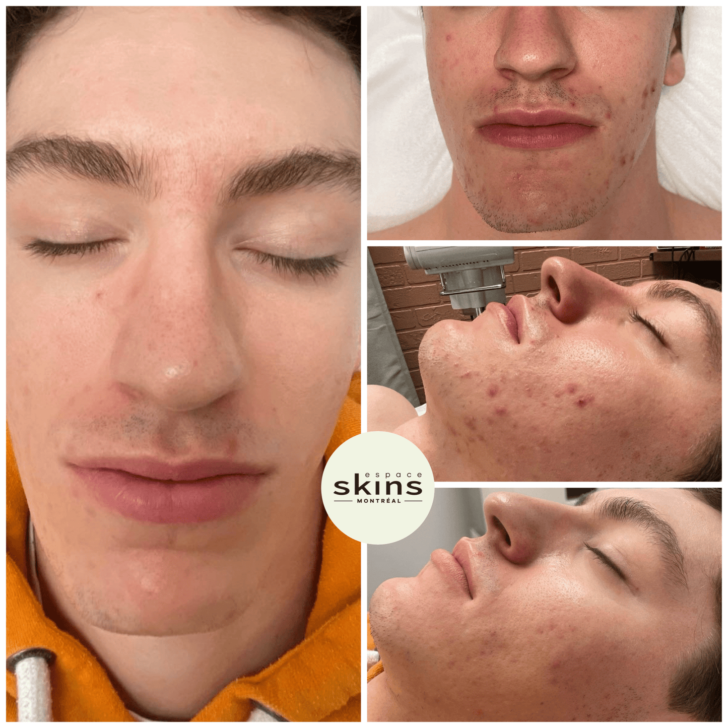 Photorejuvenation - Photofacial - Espace Skins Montreal