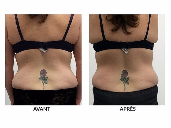 Venus Freeze Body - Espace Skins Montreal