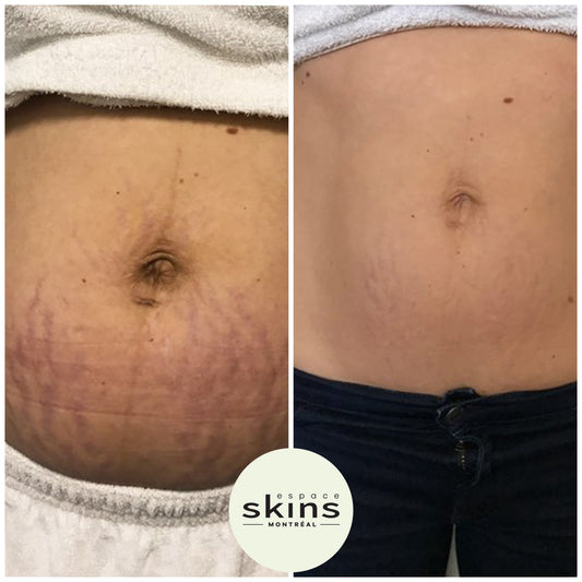 Venus Freeze Body - Espace Skins Montreal