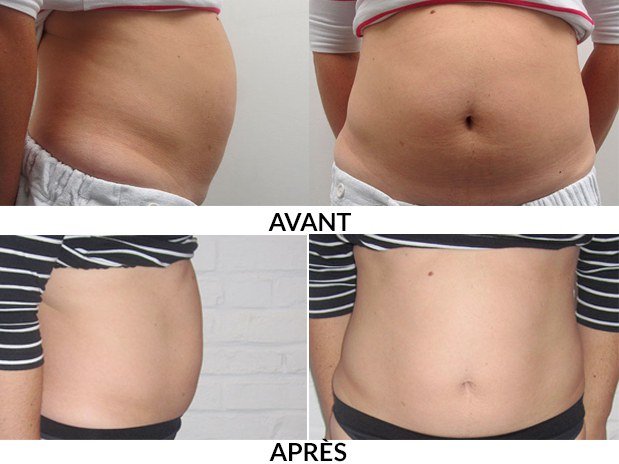 Venus Freeze Body - Espace Skins Montreal