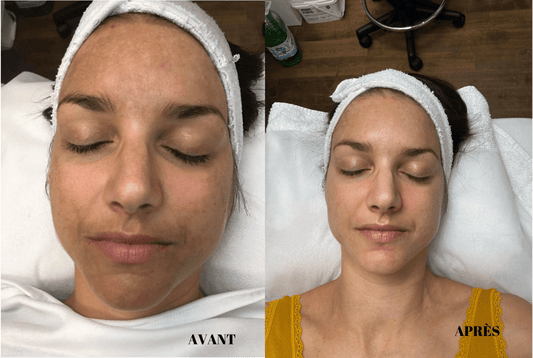 🌟 Peeling Me Line: All Your Burning Questions Answered! 🌟 - Espace Skins Montreal