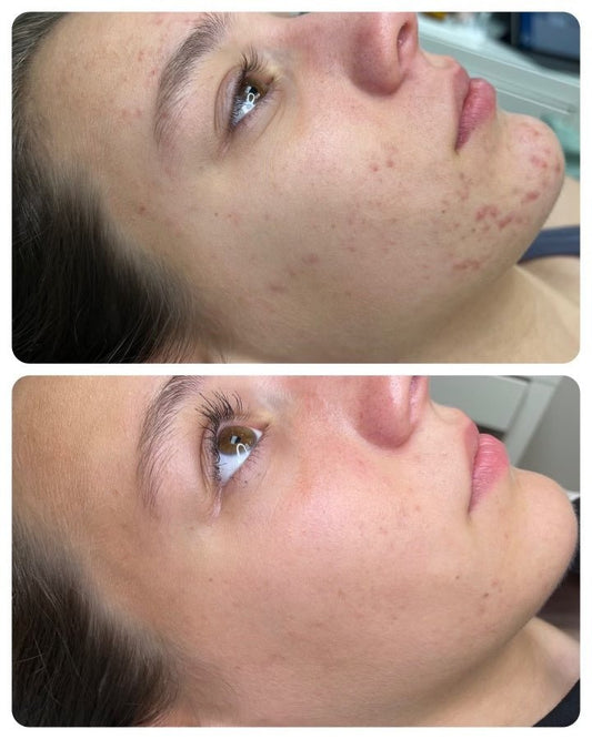 WHAT ARE THE TYPES OF ACNE? - Espace Skins Montreal