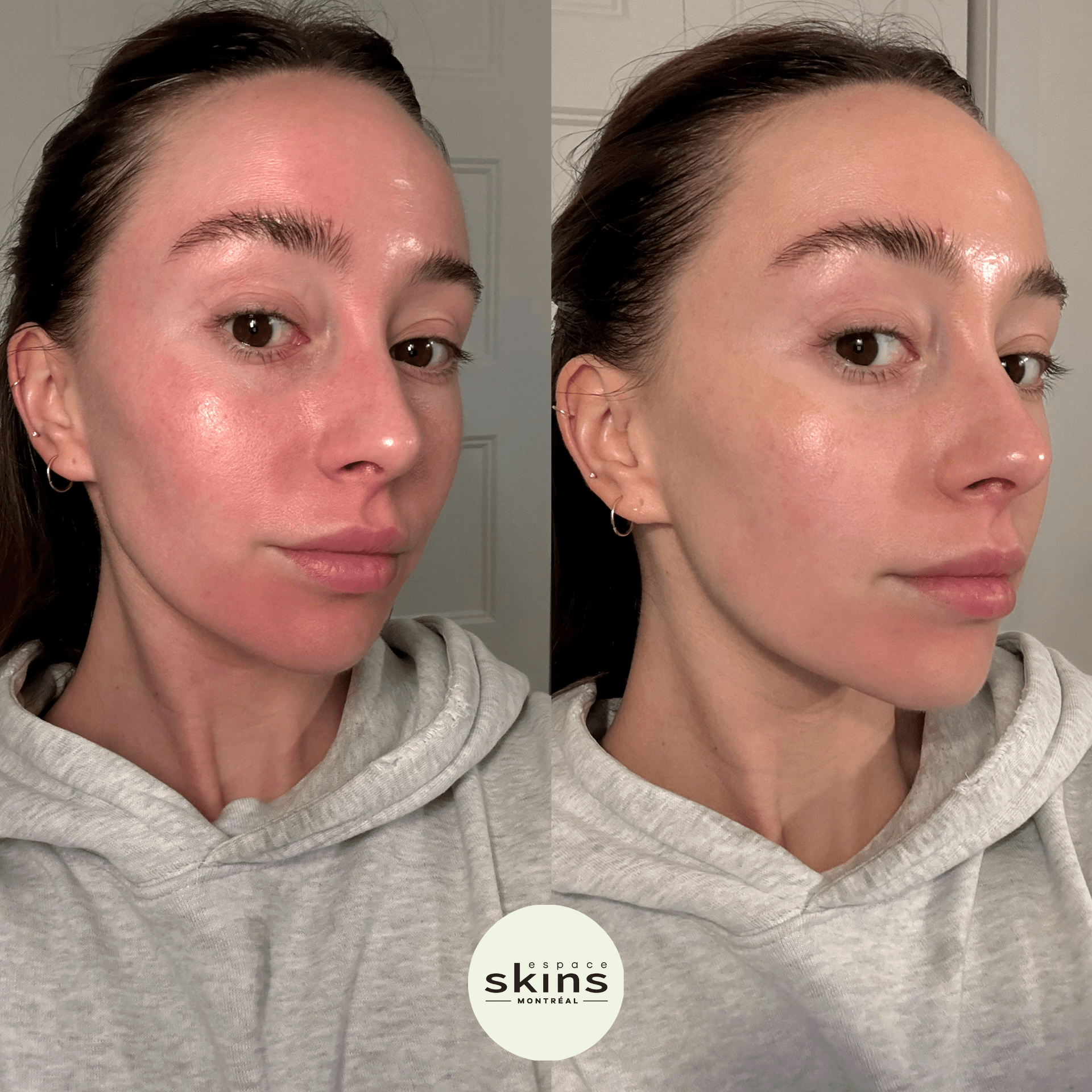 CO2 Treatment - Espace Skins Montreal