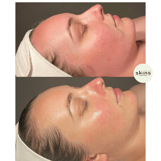 Intraceuticals Oxygen Facial - Espace Skins Montreal