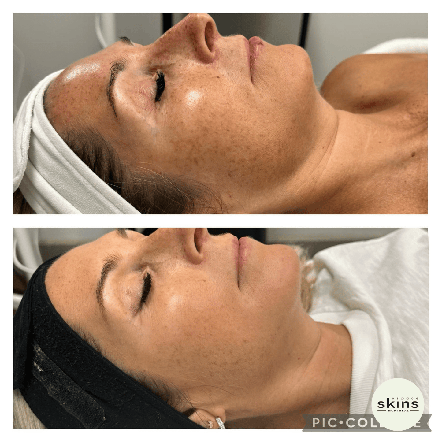 Me Line Peeling (+3 products) - Espace Skins Montreal