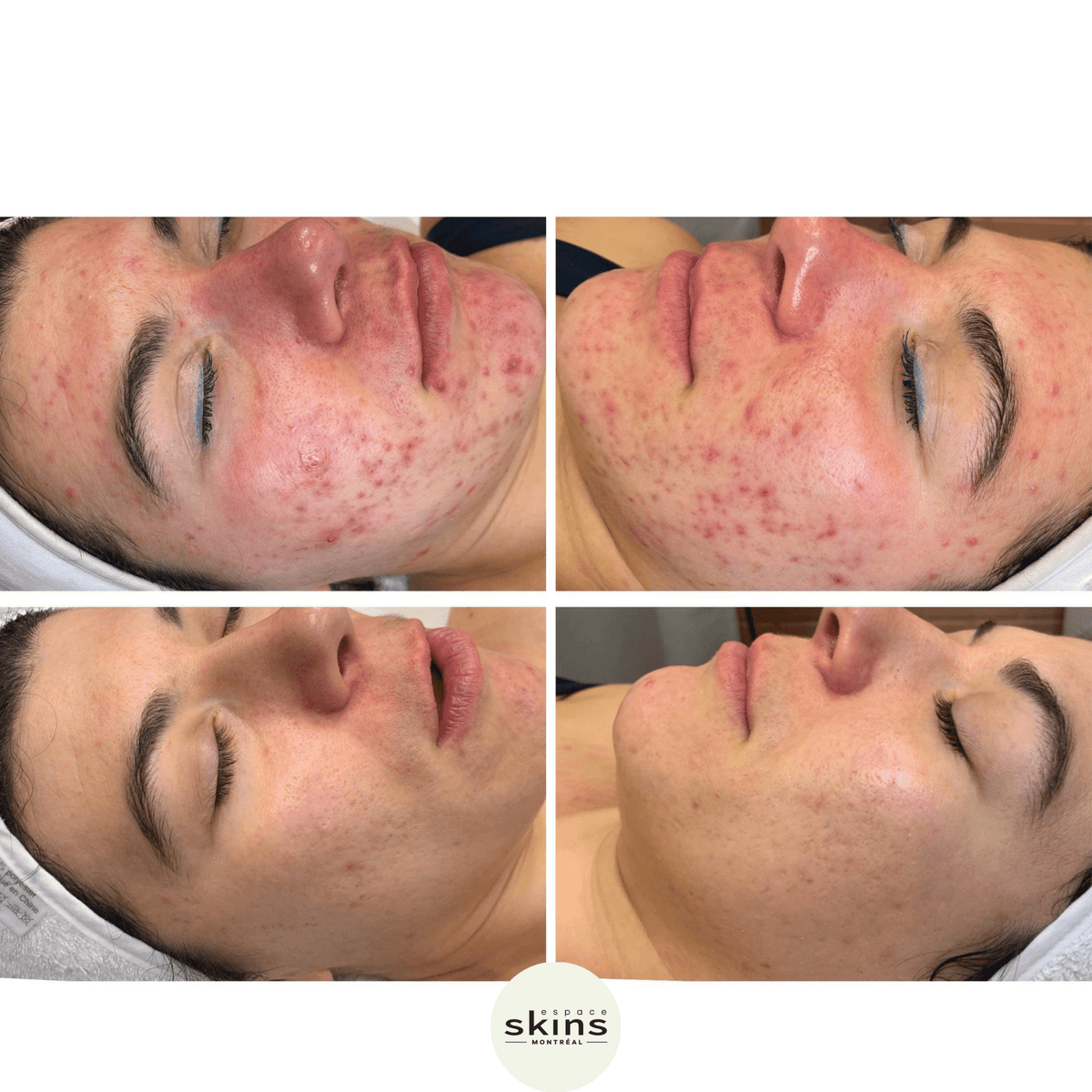 Chemical Peel Montreal | Renew, Brighten, Smooth Skin – Espace Skins ...