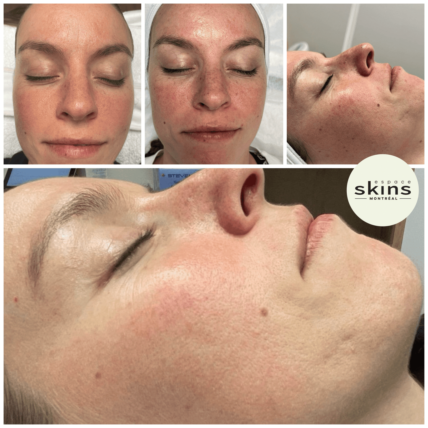 Rosacea Concern