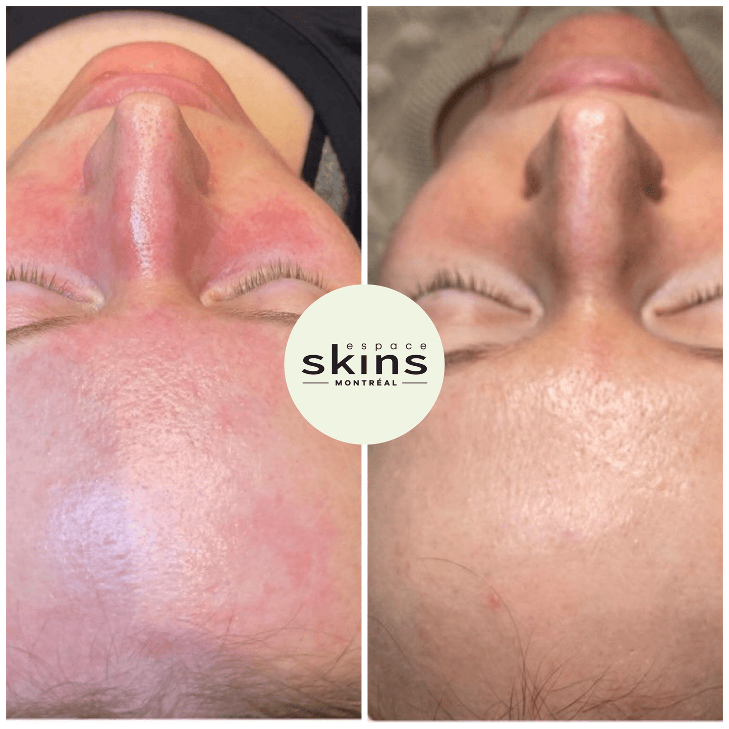 Photorejuvenation - Photofacial - Espace Skins Montreal