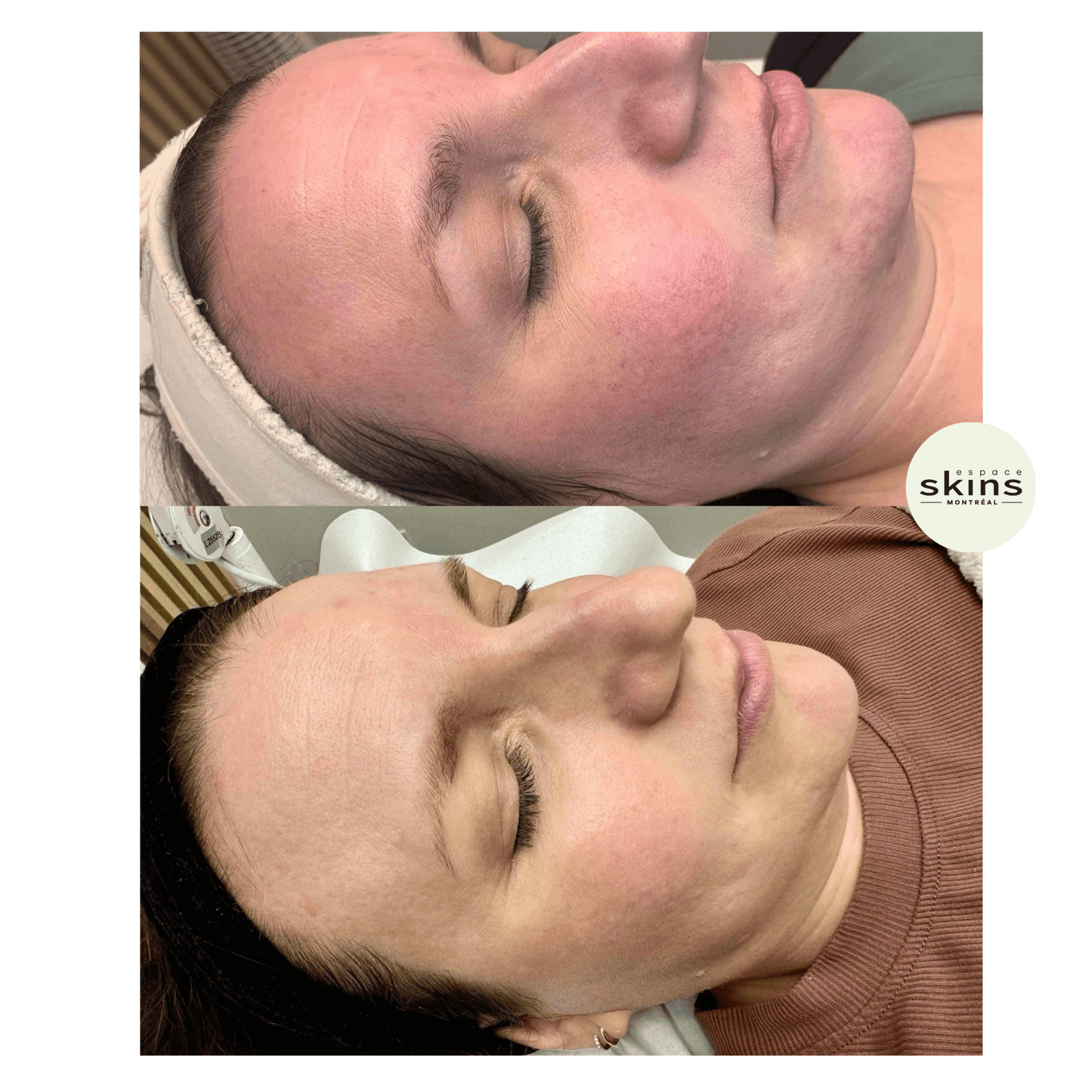 Photorejuvenation - Photofacial - Espace Skins Montreal