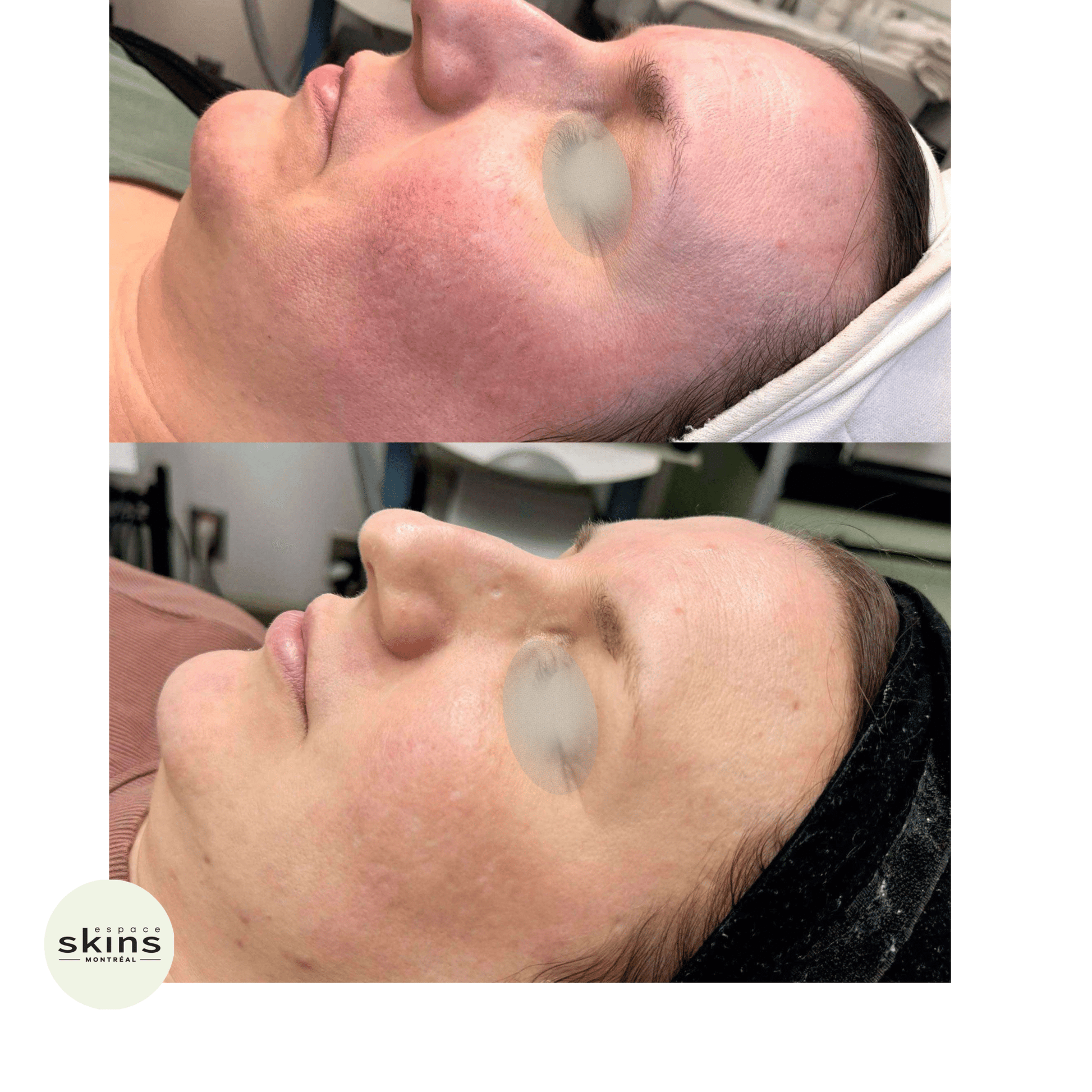 Photorejuvenation - Photofacial - Espace Skins Montreal