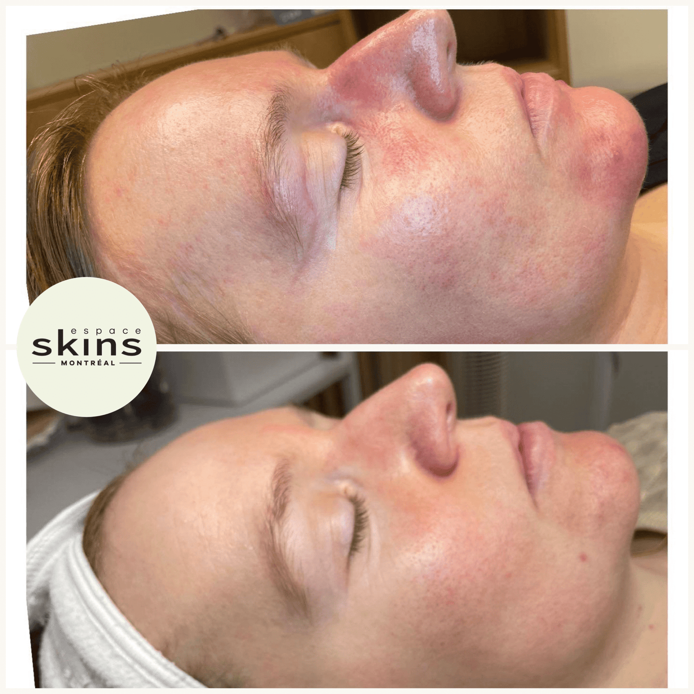 Photorejuvenation - Photofacial - Espace Skins Montreal