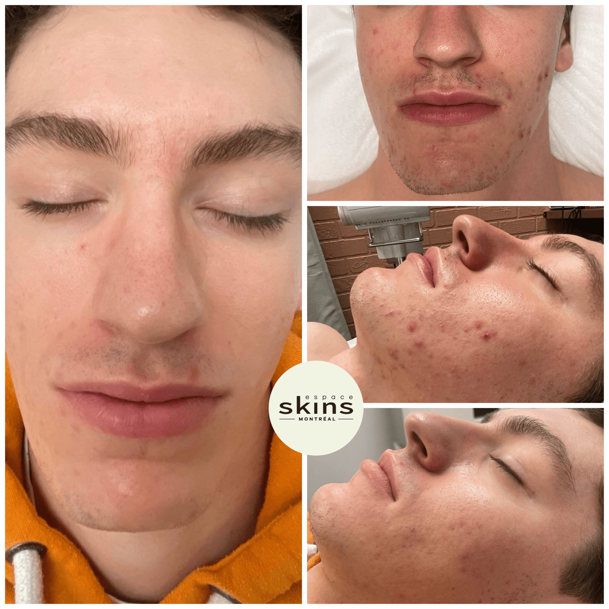 Photorejuvenation - Photofacial - Espace Skins Montreal