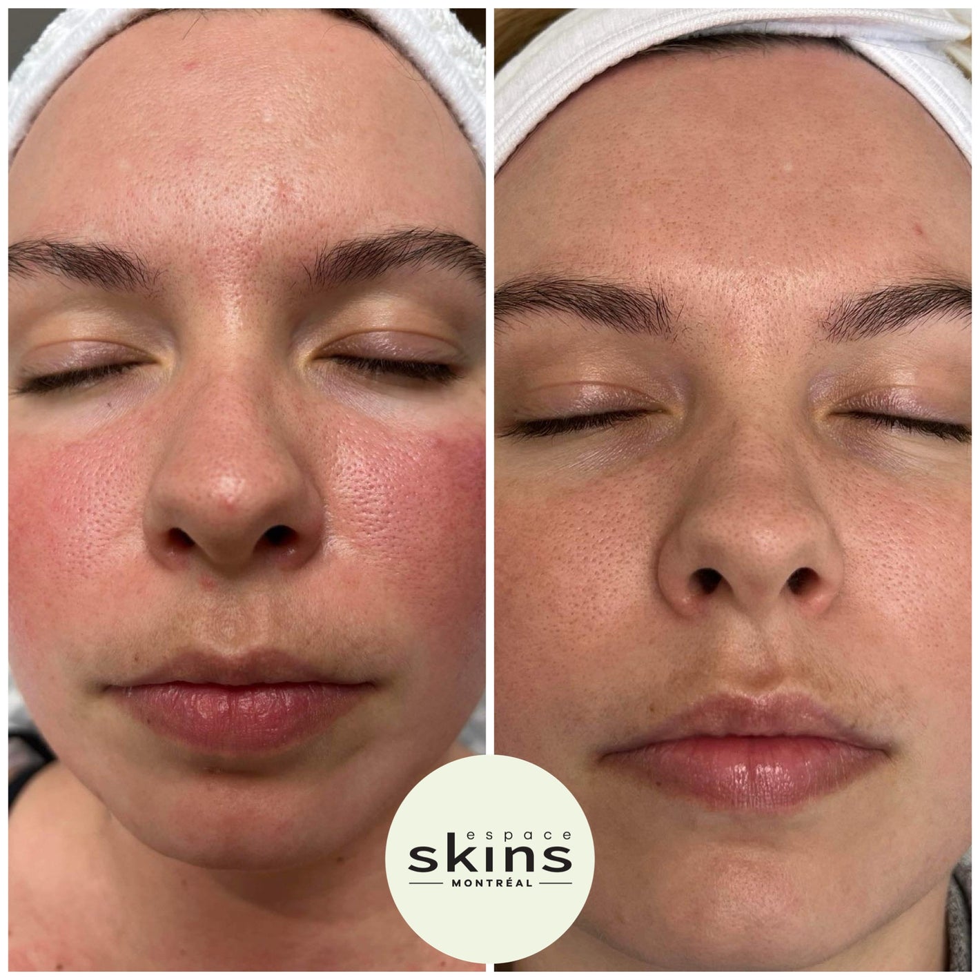 Photorejuvenation - Photofacial - Espace Skins Montreal